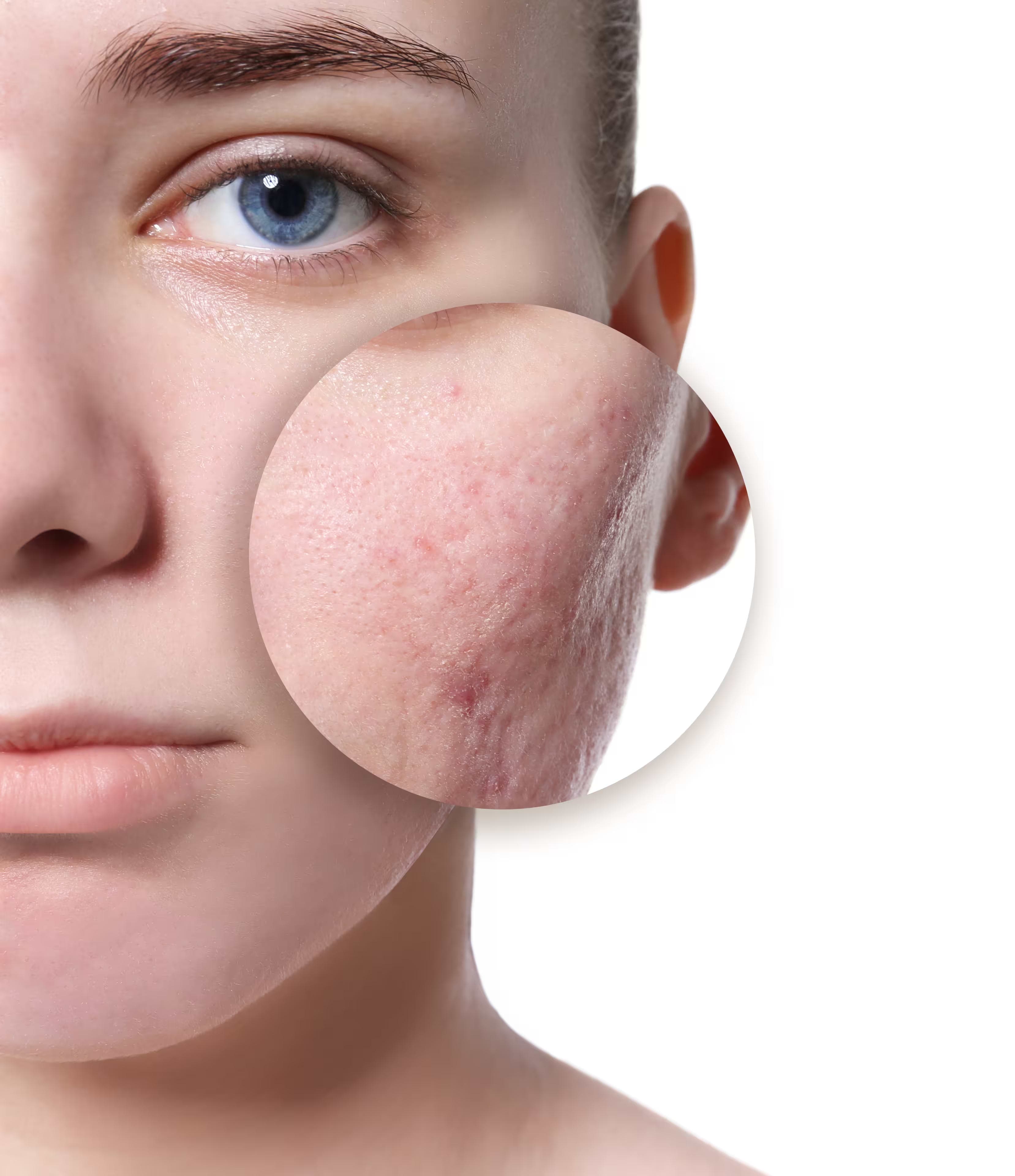Acne Scarring