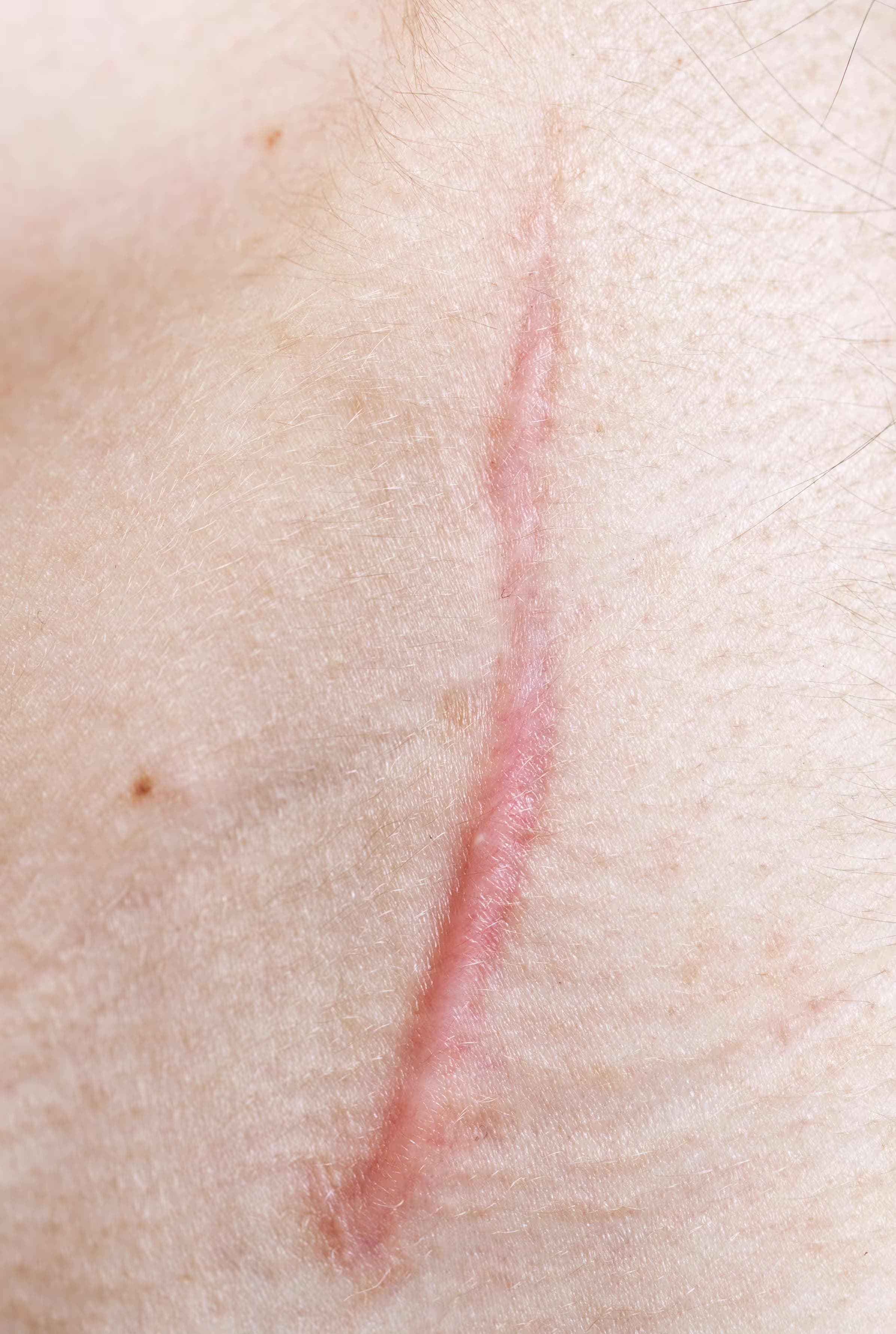 Surgical scars
